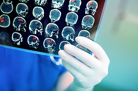 医生仔细检查病人的 Mri 扫描