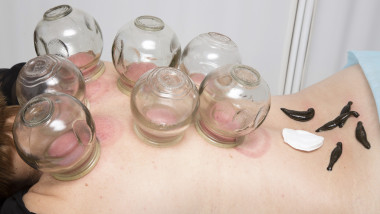 治療由真空療法和醫(yī)學(xué)水蛭人照片