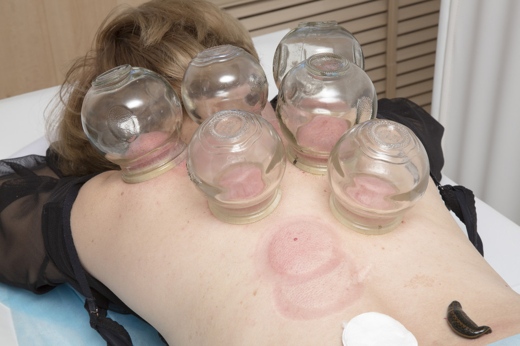 治疗由真空疗法和医学水蛭人 治疗由真空疗法和医学水蛭人