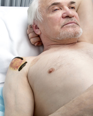 医用水蛭人和针灸治疗