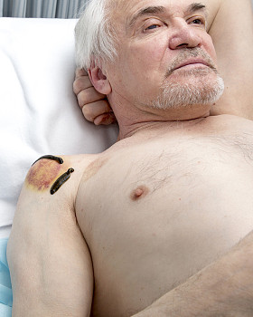 医用水蛭人和针灸治疗