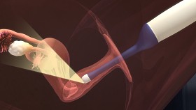 体外受精女性卵泡抽吸术