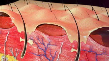 皮膚的二度燒傷