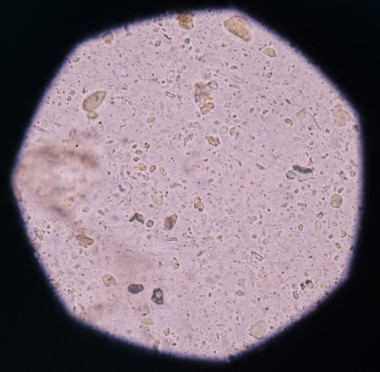 在尿路感染的细