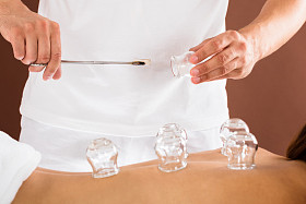 治疗师手给拔火罐治疗 图片