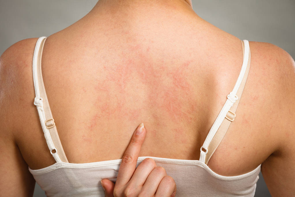 女人为她抓痒背与过敏皮疹