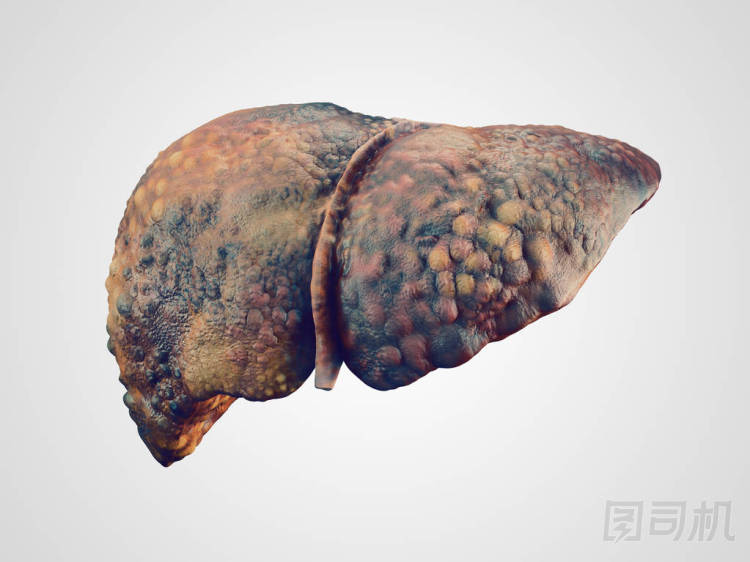 人類(lèi)肝硬化的現(xiàn)實(shí)例