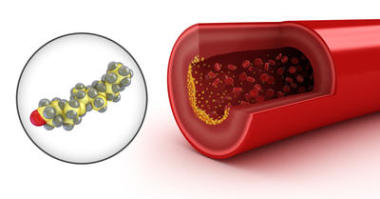 在模型中動(dòng)脈和膽固醇膽固醇斑塊