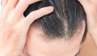 年輕男子頭發(fā)損失概念嚴(yán)重脫發(fā)的問題