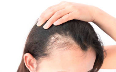 保健洗發(fā)水和美容產(chǎn)品概念中的婦女嚴(yán)重脫發(fā)問題