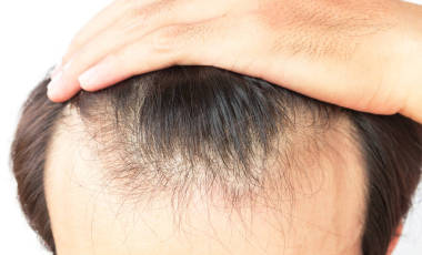 年輕男子擔(dān)心脫發(fā)問題為衛(wèi)生保健洗發(fā)水和美容產(chǎn)品概念