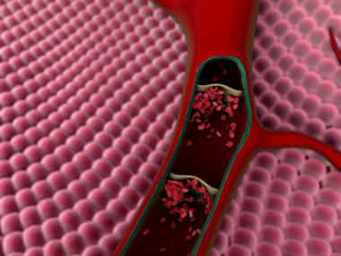 在血管中的血凝块