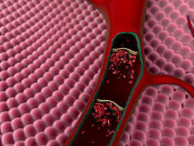 在血管中的血凝块