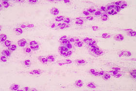 败血症是一种危及生命的疾病