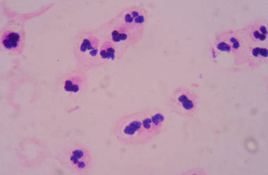 敗血癥是一種危及生命的疾病