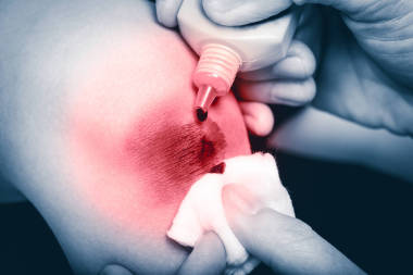 媽媽清潔和紅斑瘡面積兒子腿上提供急救的傷口