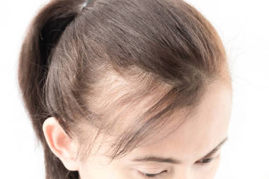 女人嚴(yán)重脫發(fā)問題 