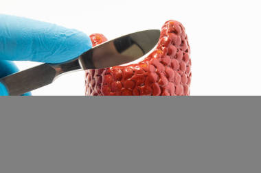 甲狀腺手術(shù)。緩繳的戴著手套的手外科手術(shù)刀的甲狀腺體積模型的外科醫(yī)生。對(duì)甲狀腺手術(shù)操作概念這種甲狀腺切除術(shù)、 癌癥及內(nèi)分泌疾病