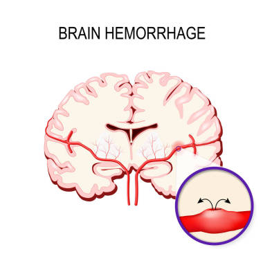 腦出血。中風(fēng)和大腦的內(nèi)部出