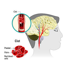 脑梗死。脑中风照片