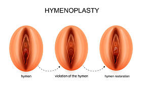 处女膜修复术。妇科
