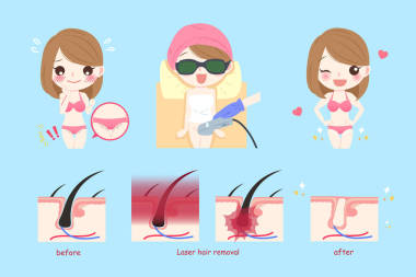 激光比基尼线头发概念照片