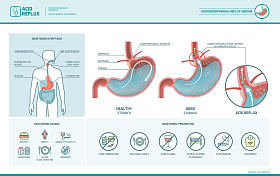 酸反流和胃灼热图图片