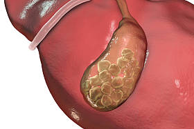 胆结石，插图显示底部视图的肝脏和胆囊结石