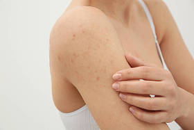 女人抓疹子的肩膀图片