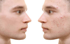 年轻男子痤疮治疗前后的白色背景。护肤理念