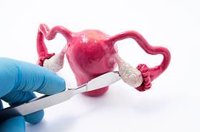 卵巢妇科手术概念。手外科医生用手术刀附近女性生殖器的象征如癌症,除卵巢和管囊肿、 膀胱切除术作为治疗的外科干预