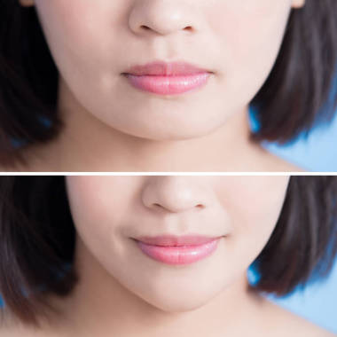 手术的尖下巴的女人 图片