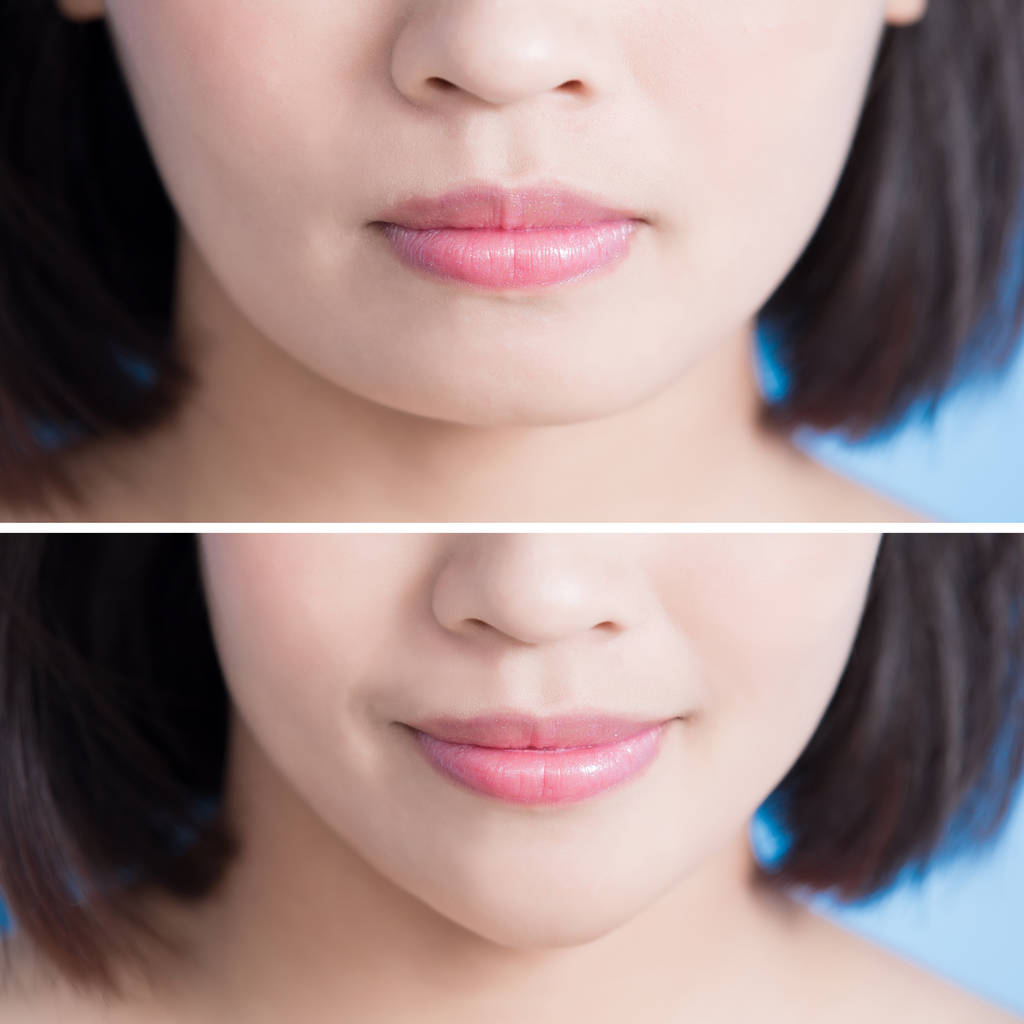 手术的尖下巴的女人 图片 手术的尖下巴的女人 图片