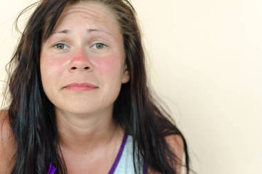 晒伤女性脸图片