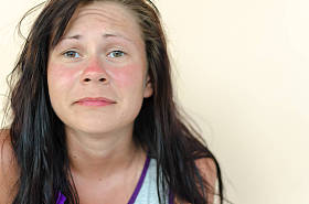 晒伤女性脸图片