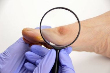 脚拇趾囊肿图片