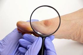 脚拇趾囊肿图片