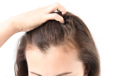 保健洗發(fā)水和美容產(chǎn)品概念中的婦女嚴(yán)重脫發(fā)問題