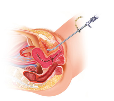 女性 cistoscopia
