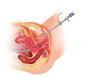 女性 cistoscopia