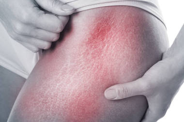 用拉伸標(biāo)記關(guān)閉女性臀部的視圖