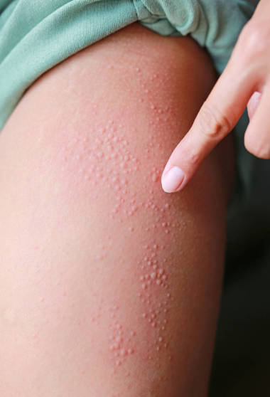 皮膚近端過敏性皮疹皮炎濕疹