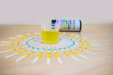 尿液标本连同蘸棒 uristix 对糖尿病患者尿糖蛋白的分析