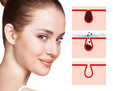 美麗的婦女展示如何污染和清潔臉上的毛孔