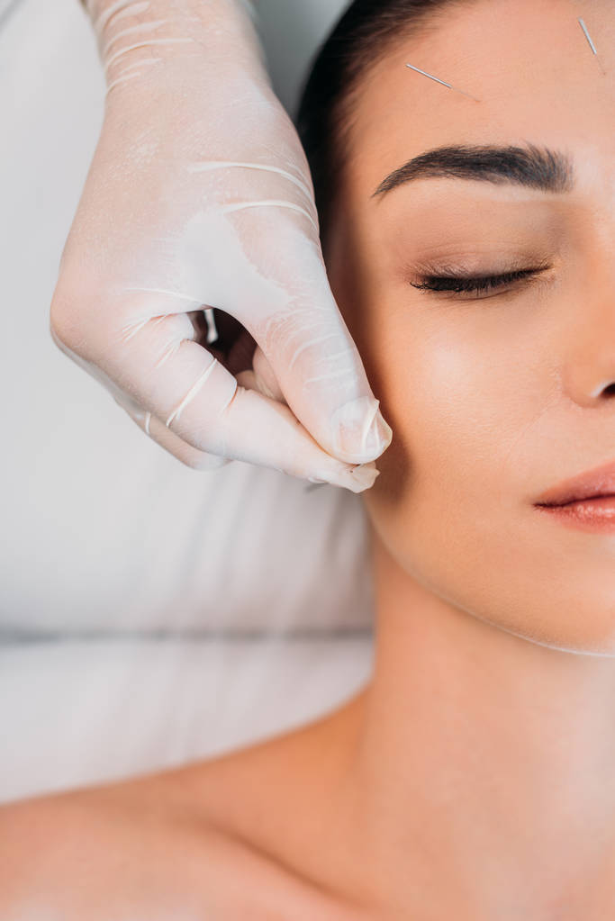 温泉沙龙针刺治疗女子前额美容师针的部分观察 温泉沙龙针刺治疗女子前额美容师针的部分观察