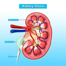肾结石的解剖