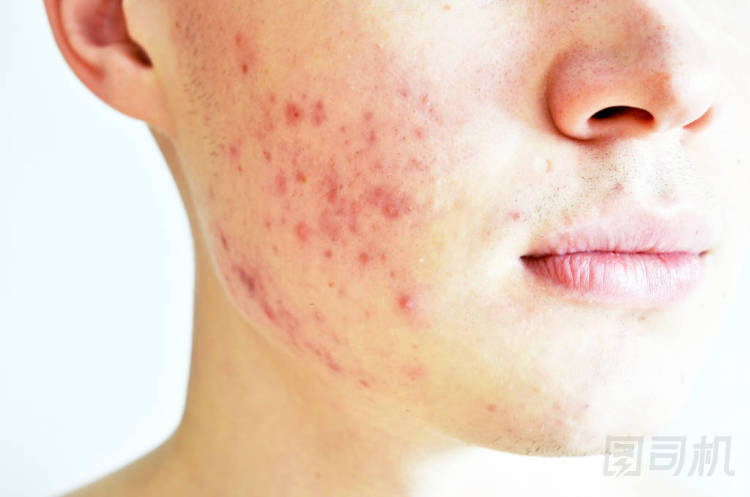 關(guān)閉有問題的皮膚和痤瘡疤痕的人