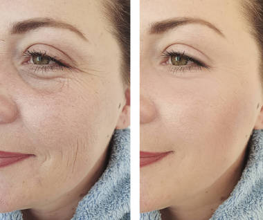 女性皱纹前后的纠正程序照片