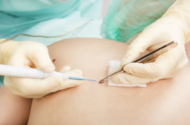 电波电凝鼹鼠删除方法