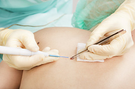 电波电凝鼹鼠删除方法